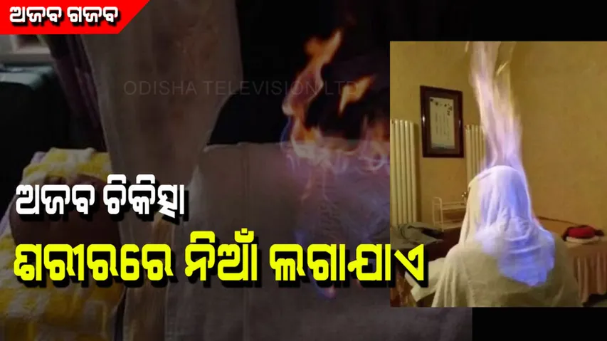 Fire therapy treats people by burning body