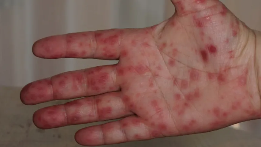 82 Cases Of Tomato Flue Detected In Kerala 