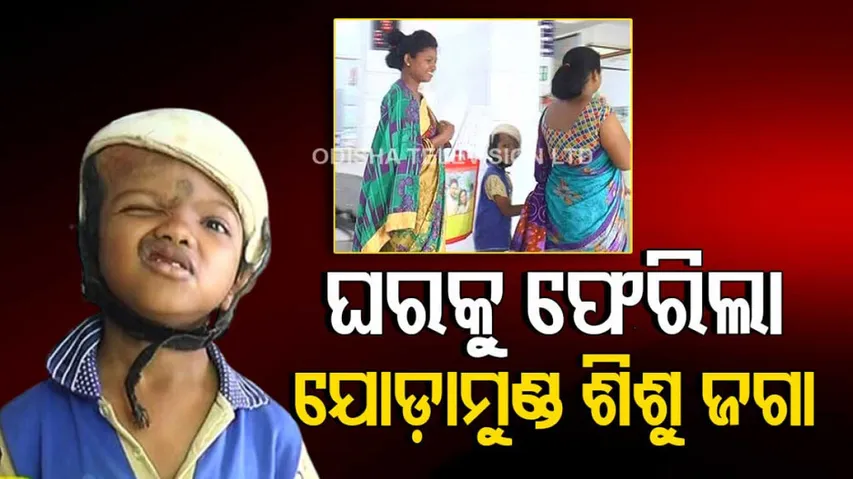 Conjoined Twins Survivor Jaga