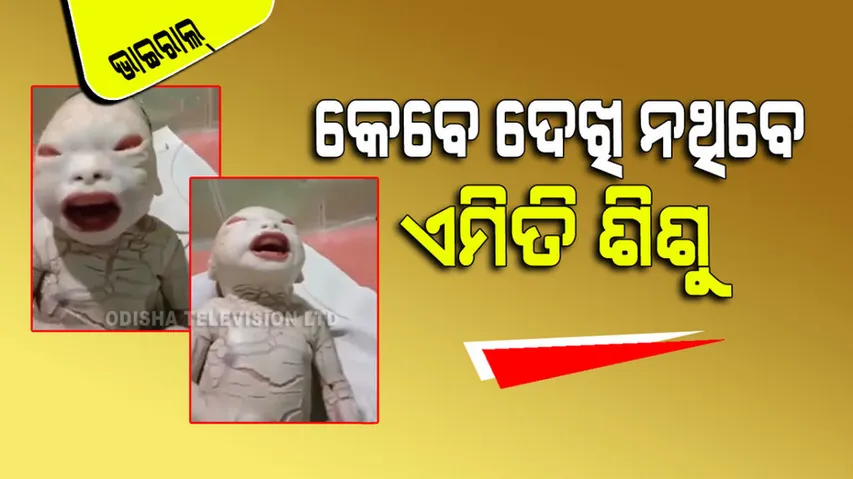 harlequin ichthyosis baby