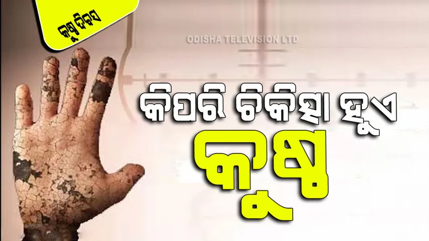 Symptoms causes and treatment of leprosy