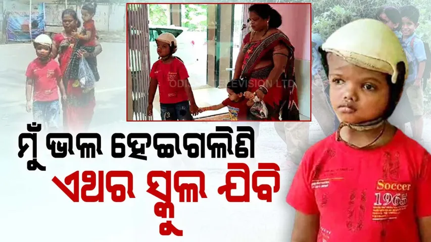 Odisha Conjoined Twins Survivor Jaga to Go School