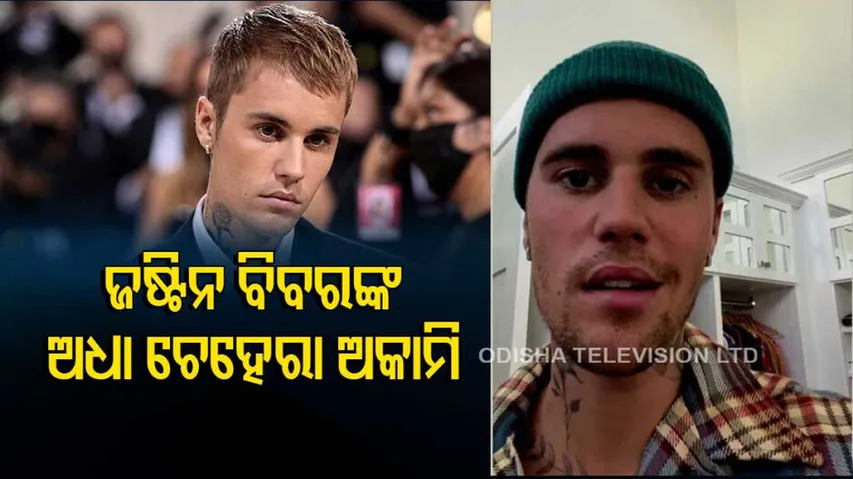Justin Bieber Says He Has Facial Paralysis
