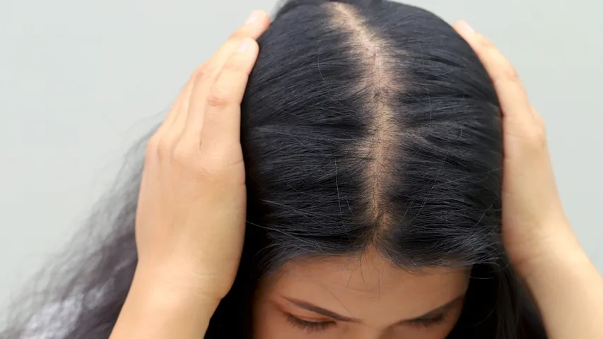 Hairfall in women