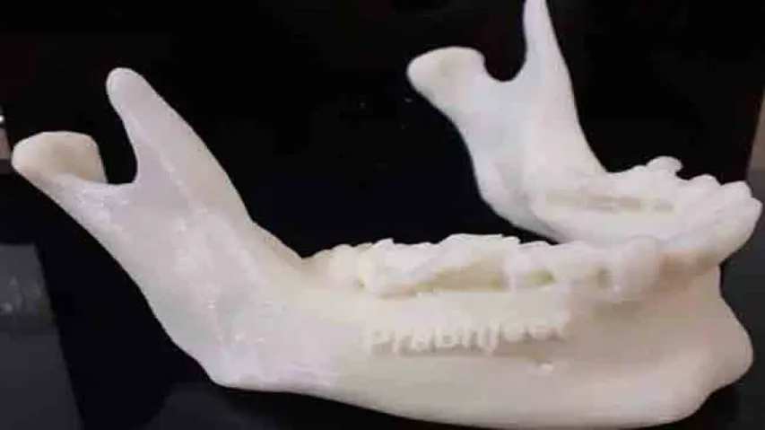 3D-printed jaw helps Indian oral cancer survivor eat everything
