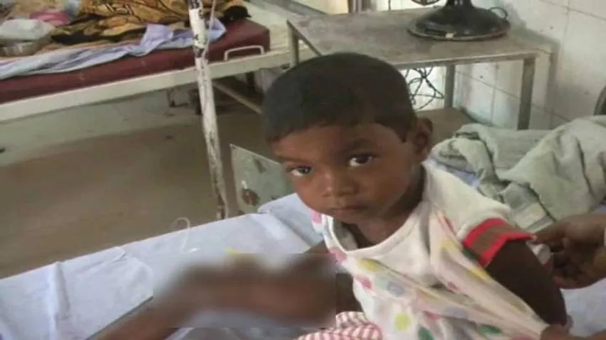 Girl child injured after Anganwadi cook 'accidentally' throws boiled water on her
