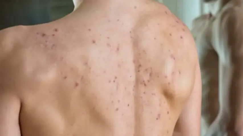 Acne free skin