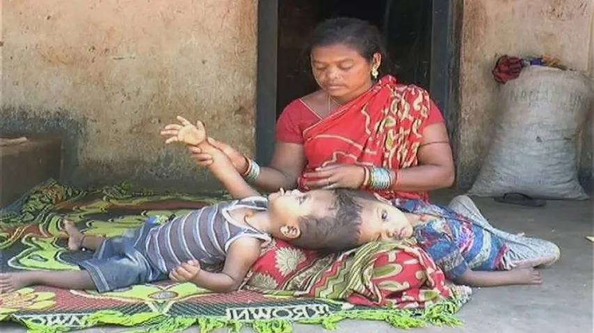 Conjoined twins wait for support to lead separate lives in Kandhamal