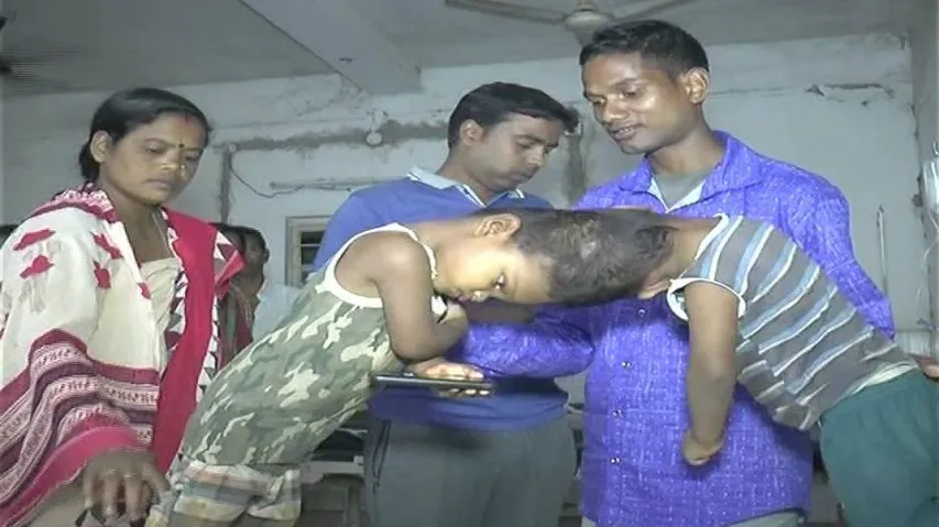 OTV Impact: Kandhamal Conjoined Twins to head for AIIMS tomorrow