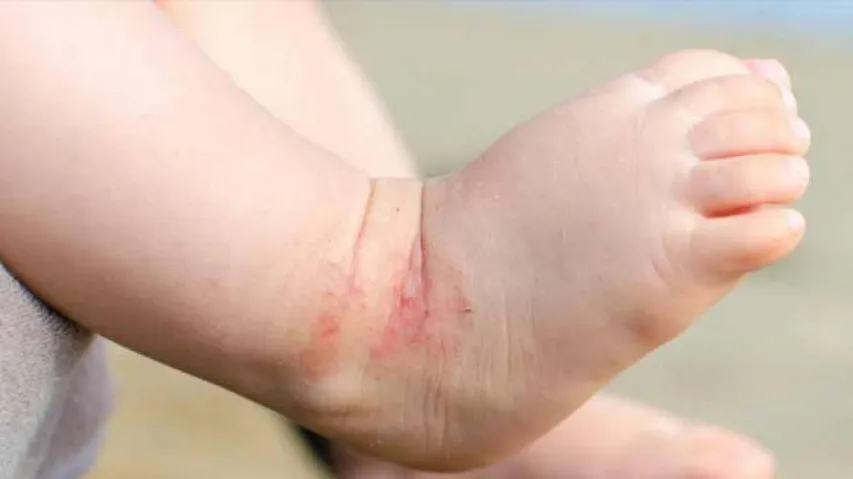 Using Daily Moisturisers Cannot Prevent Eczema In Babies
