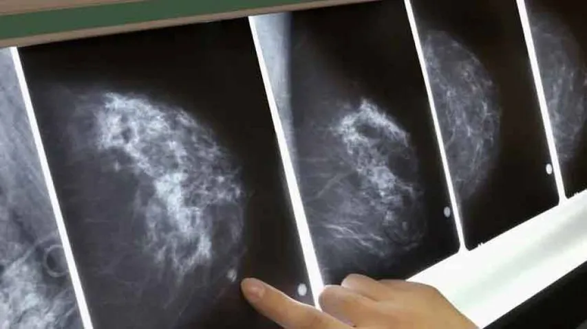Google AI Model Beats Humans In Detecting Breast Cancer