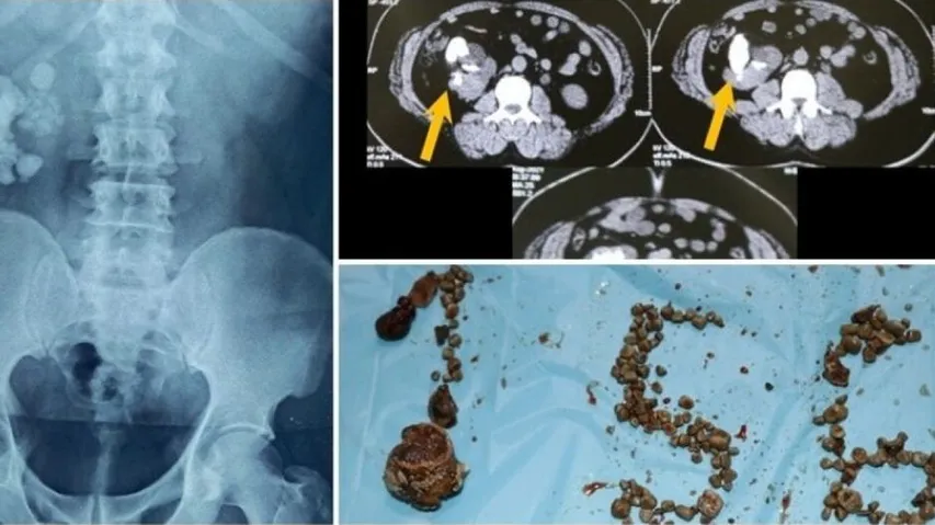 156 Renal Stones From Removed From Man At Hyderabad Hospital