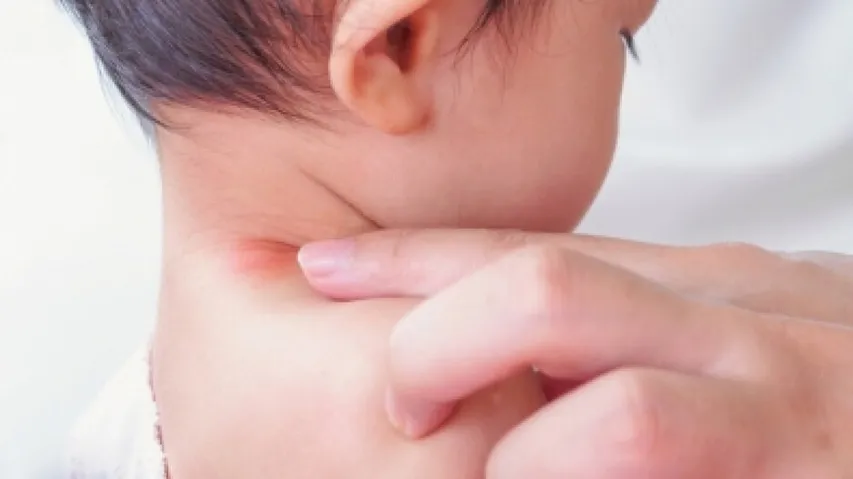 5 Ways To Manage Childhood Allergies