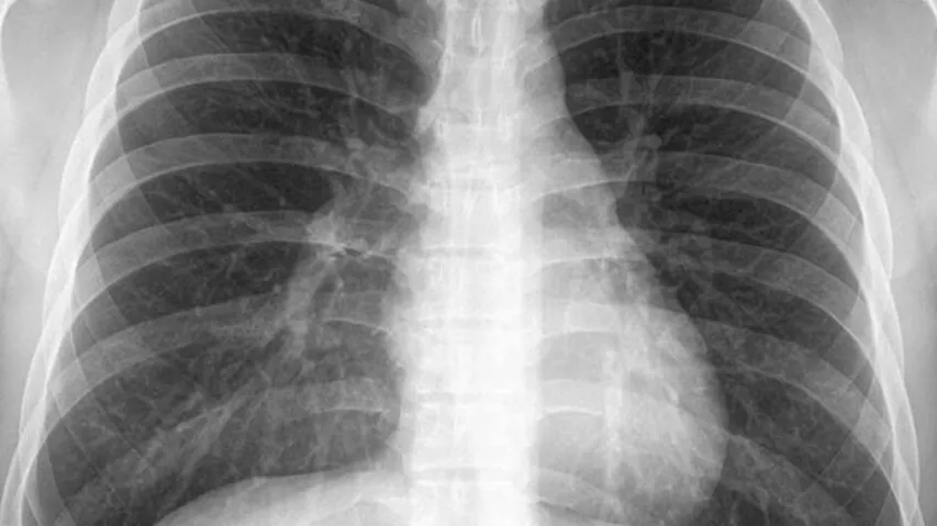 Chest X-Ray