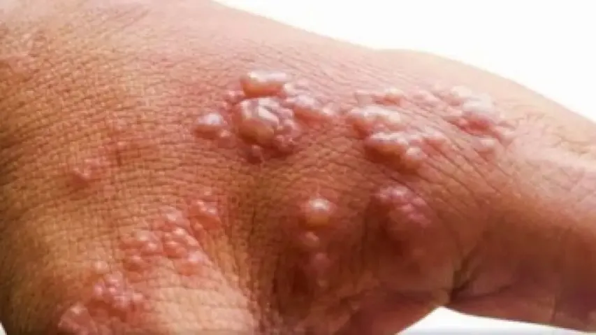 Australia declares monkeypox disease of national significance