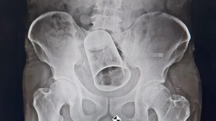 Glass In Stomach 