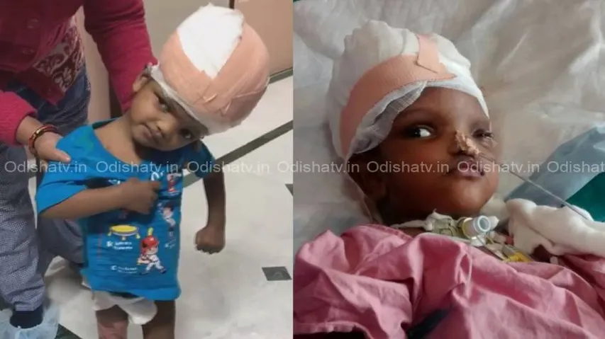 Separated conjoined twins: Jaga starts walking, Kalia opens eyes