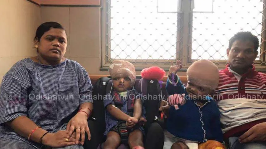 Health Condition Of Separated Conjoined Twins Jaga, Kalia 'Improving'