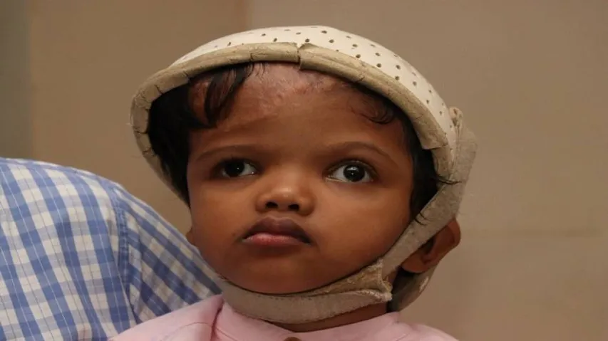 Odisha: Separated Craniopagus Twin ‘Jaga’ To Return To Home District