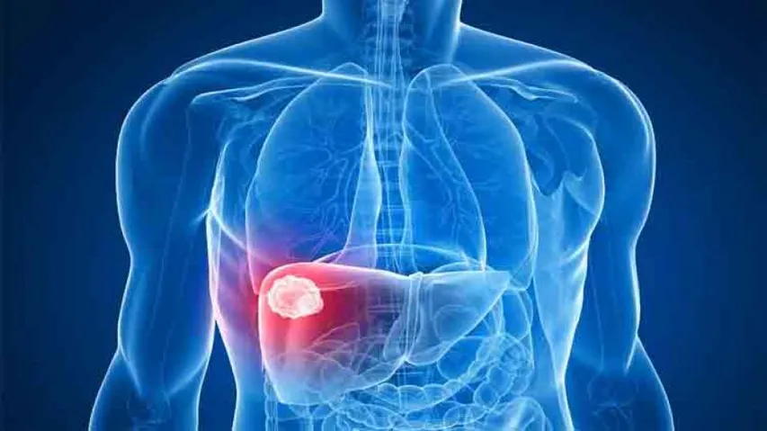Gut microbiota can aid in early diagnosis of liver cancer
