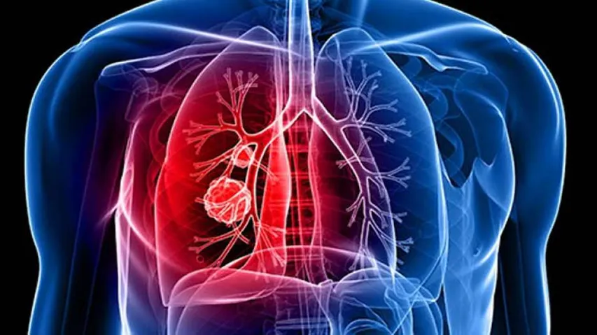 Novel model to predict lung cancer survival developed