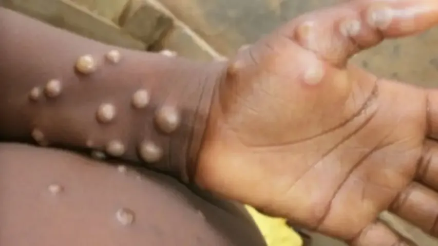 Monkeypox