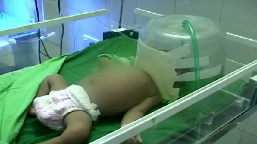 Nabarangpur: Another infant branded with hot iron rod