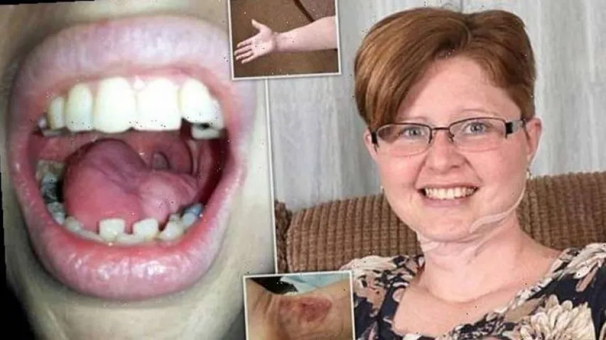 Woman Gets Tongue Made From Arm Skin