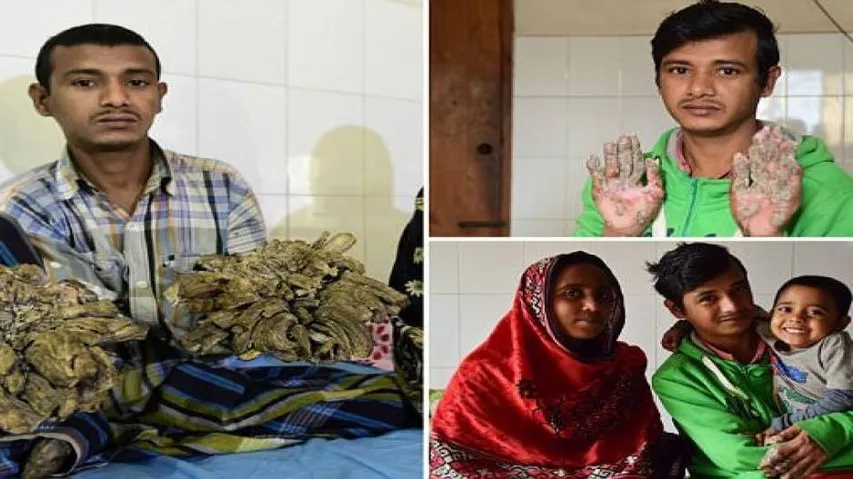 Bangladesh 'tree man' trapped in hospital for two years
