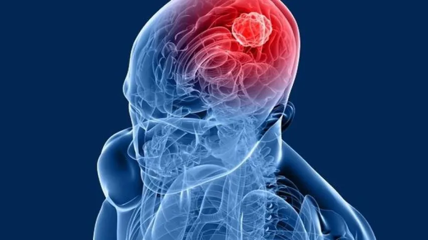 Brain tumour no longer scary, say doctors