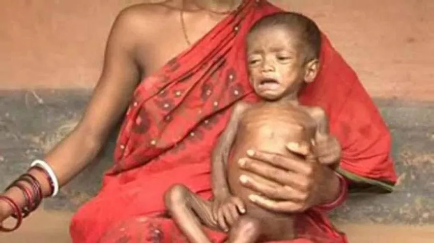 From 1990 - 2017, Malnutrition deaths still haunt Odisha!