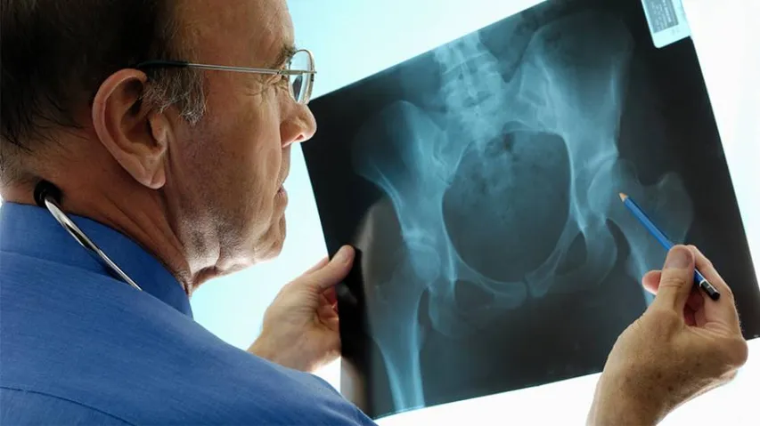 What causes bone loss? Find out