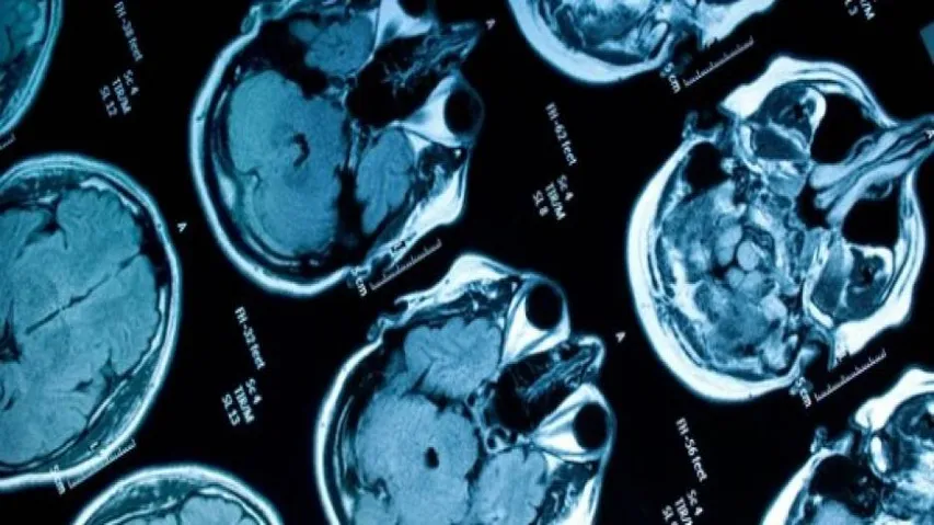 Brain scans help predict learning problems: study