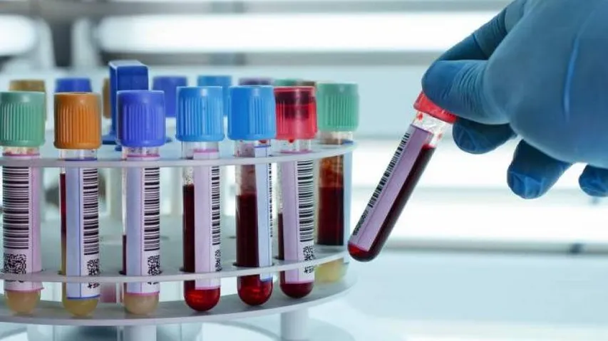 New blood test to screen for secondary heart attack