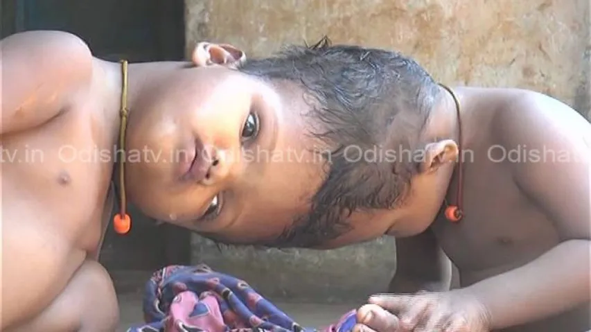 Conjoined twins’ surgery: Govt employees urged to donate day’s salary