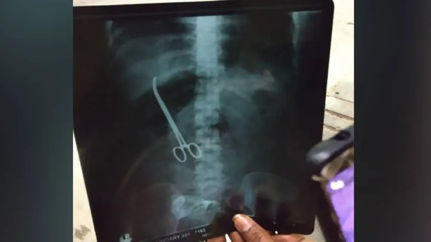 Doctors at Hyderabad's NIMS leave forceps in patient's abdomen