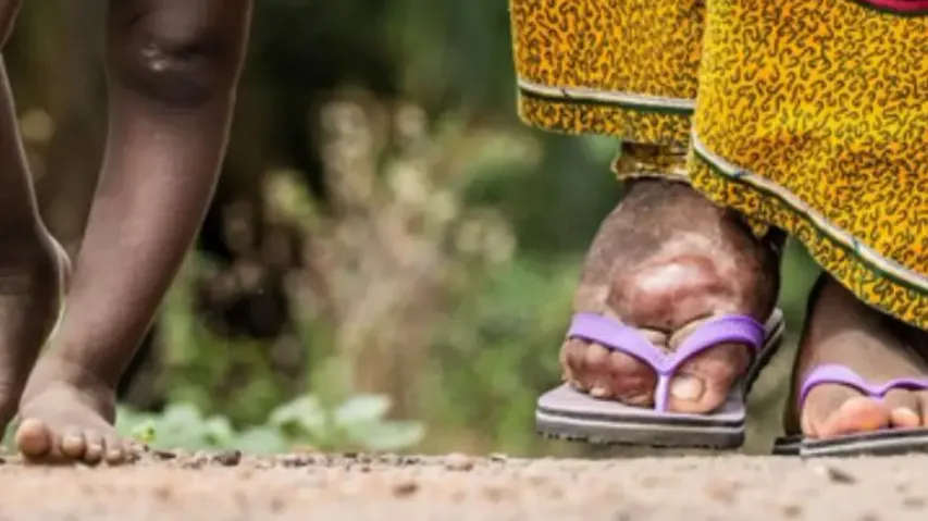 India committed to eliminating lymphatic filariasis by 2027: Mandaviya