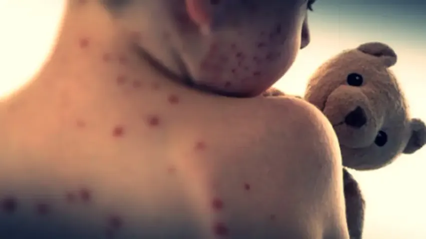 Measles vaccine 2.6x more ineffective in kids born via C-sec, study claims