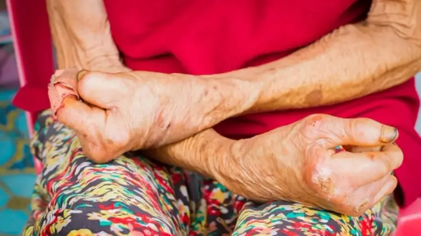 Jordan first country to eliminate leprosy: WHO