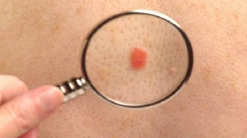World's tiniest device to prevent skin cancer, mood disorder risk