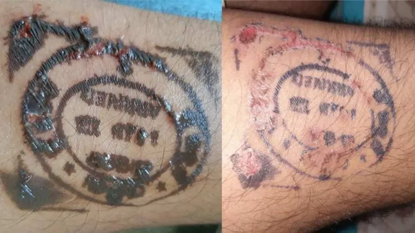 Odisha Returnees Fume After Quarantine Stamp Leaves Skin Burns, Blisters