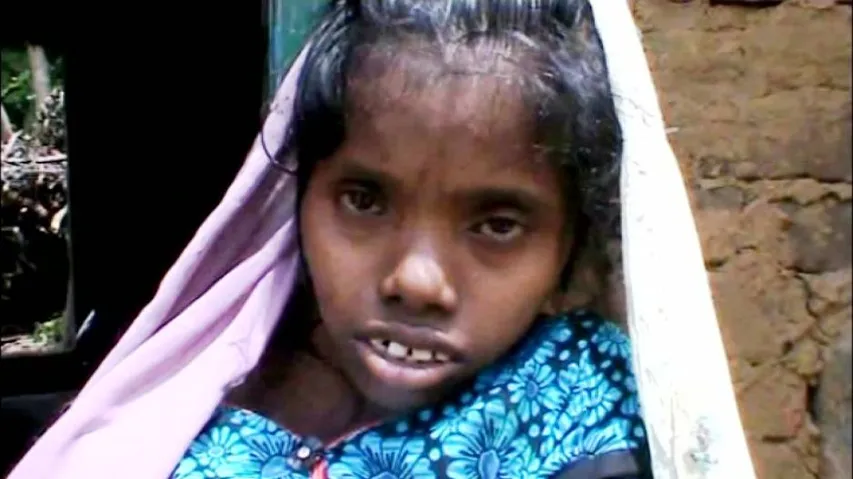 Rayagada admin to bear medical expenses of girl with rare condition