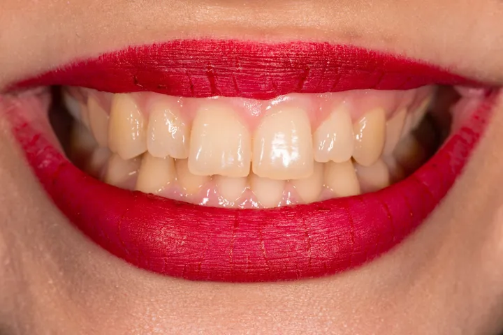 teeth7