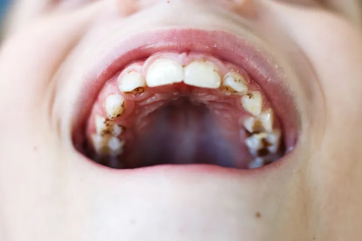 teeth9
