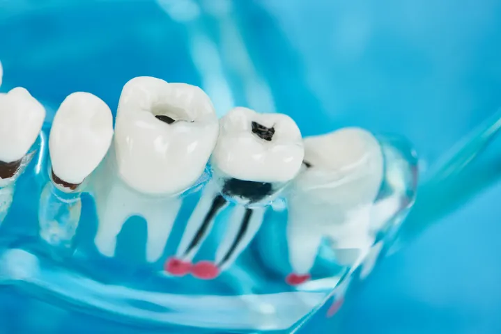 toothdecay4