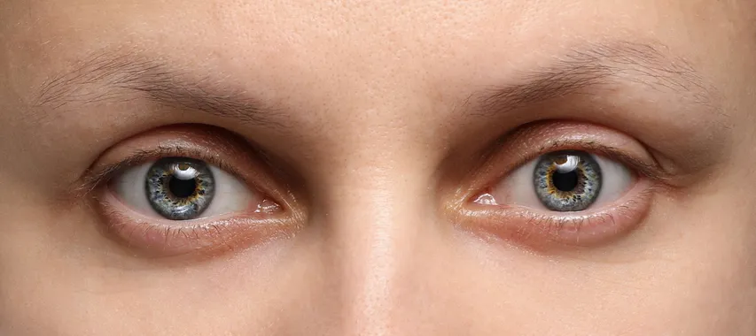 Swellingeyes4