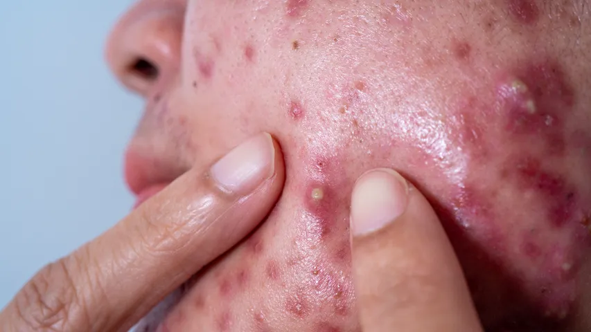 Pimples
