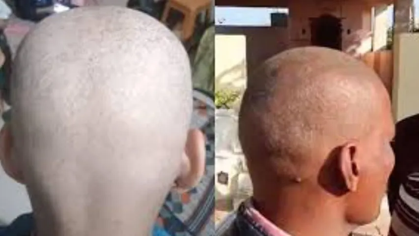 Mysterious Hair Loss