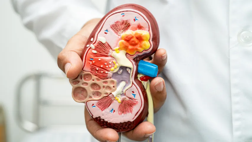 Kidney Stones symptoms