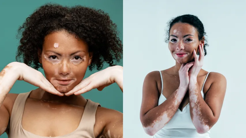 Vitiligo